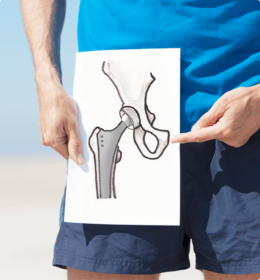 man holding a drawing of a hip implant